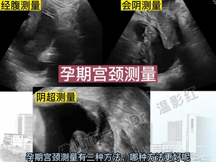 孕期宫颈测量选择!#超声影像 #超声学习 #宫颈 #宫颈机能不全 #环扎保胎
