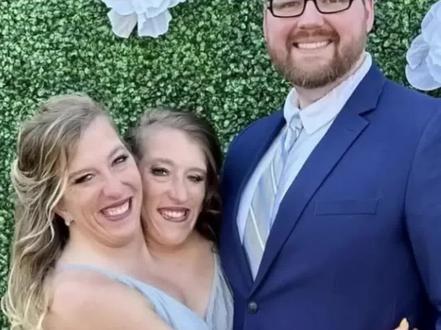 连体姐妹一方结婚,另一方的生活相当尴尬 #连体人 #连体姐妹结婚