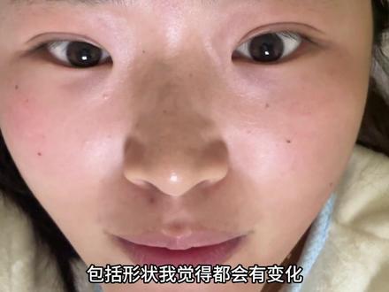 全切双眼皮一年多的样子#原相机无美颜滤镜 #双眼皮蜕变记 #双眼皮恢复记录 #全切双眼皮 #行业大揭秘