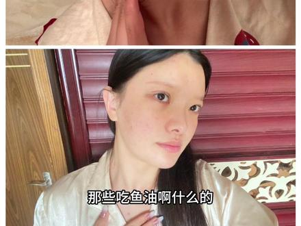 医院里懂点医疗知识一些护士小姐姐为了皮肤变好都会自己去吃 不过还是谨遵医嘱