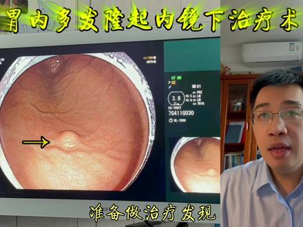 外院发现胃隆起性病变,住院发现多发粘膜下隆起,看如何一次性切除两个病变,早诊早治最重要!#消化青年论坛 #明说鑫语 #创作灵感 #胃镜