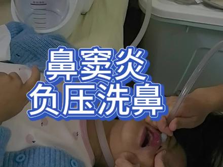 鼻窦炎发作急性期浓鼻涕非常多自己流不出来,我们会用负压洗鼻机将鼻涕抽出来,这样小孩会相对舒服很多,它相对于普通的洗鼻壶洗得更干净些,也更安全不会导致中耳炎。#鼻窦炎#鼻炎#洗鼻子#洗鼻子护理 #负压洗鼻