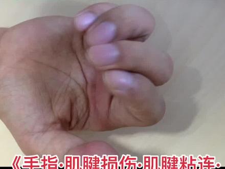 肌腱松解术要掌握适应症以及术后注意功能锻炼#手#手指#外伤#手外伤#骨折#肌腱断裂#肌腱修复#手术#肌腱粘连#肌腱松解#手外伤#功能锻炼#康复#理疗#手外科#武汉协和医院#武汉协和医院李涛#医学科普#医学知识#科普#医学#健康#健康最重要#抖音#抖音小助手