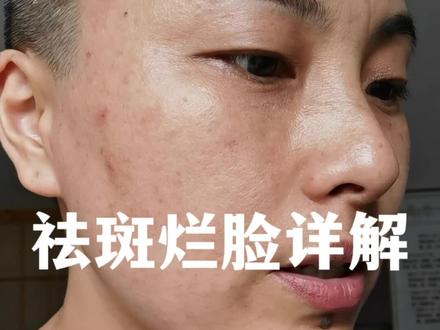 祛斑弄不好会毁容的#祛斑 #避坑指南 #美容#烂脸#戈壁天后