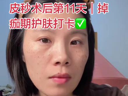 皮秒第11天,痂还没掉完,皮肤有些干,真的很怕反黑和留印。今天开始用可复美这款修复敷料乳液,掉痂的地方薄涂修复屏障,没掉的痂也能轻轻带过软化它,让它自然脱落。术后修复全靠它稳住,安心又靠谱~#可复美 #可复美R乳 #皮秒后反黑 #激光术后修复
