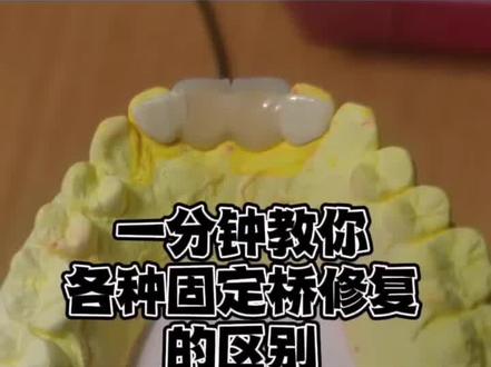 一分钟小课堂
#了解粘接桥与其他固定修复的区别