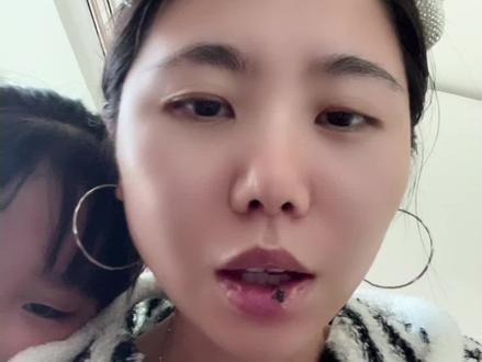 #唾液腺囊肿 手术第六天啦!