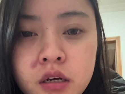 切痣后你们比较关系的问题
流程 医生 还有费用 地点 术后护理
#拒绝废话 #dou上热门🔥 #切痣分享 #切痣恢复
