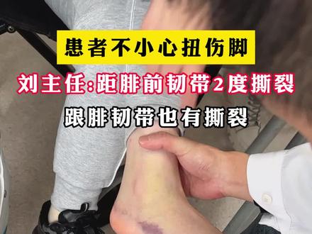 患者不小心扭伤脚,她的距腓前韧带2度撕裂了,跟腓韧带也有撕裂,#脚痛 #韧带撕裂 #扭伤 #dou来说健康 #足踝