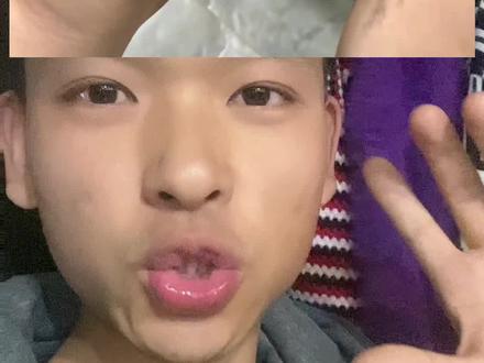 如果你也用了爆雷的泰国美白身体乳 现在要做的就是:立刻停用,彻底清残留!
马上把这款美白身体乳扔了,绝对不能再用了!然后赶紧用温和的氨基酸沐浴露,从头到脚轻柔清洗所有涂过的部位,尤其是皮肤开裂的地方,千万千万别使劲搓,不然伤口会更疼、破损更严重!洗完澡后,拿干净无菌的纱布,或者一次性棉签,轻轻把身体水分“蘸干”,记住是“蘸”不是“擦”,一擦就会摩擦刺激伤口,加重损伤!
接着:紧急护伤口,别让它恶化!
皮肤已经开裂了,千万别不管!赶紧去药店买医用凡士林,或者重组人表皮生长因子凝胶,薄涂在开裂的地方,能形成一层保护膜,帮皮肤慢慢修复,还能挡住细菌,避免感染发炎。如果开裂的地方还红肿、往外渗液,先拿无菌生理盐水浸湿纱布,湿敷在上面,每次敷10-15分钟,一天敷2-3次,能减轻炎症,缓解刺痛感,别乱用偏方涂东西,越涂越糟!
最后🏥 :别犹豫,必须去医院!
这步真的重中之重,千万别觉得“忍忍就好了”!第一,汞这东西会通过身体皮肤偷偷吸进血液里,慢慢损伤肾脏,还可能出现头晕、没力气、恶心这些全身症状,越拖越难治疗;第二,皮肤开裂很容易感染,医生会专业处理伤口,开针对性的修复药,还会检测血汞、尿汞,必要时做驱汞治疗,这些都是自己在家搞不定的;第三,别等伤口化脓、全身不舒服了才去,早检查早治疗,才能减少伤害!#泰国美白 #佤邦 #汞中毒