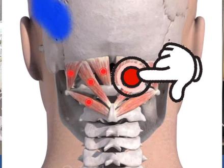 头颈不舒服就找枕后肌群#枕后肌群松解#枕后肌群拉伸#枕后肌群训练 #枕后肌群解剖 #临沂刘博士运动康复中心