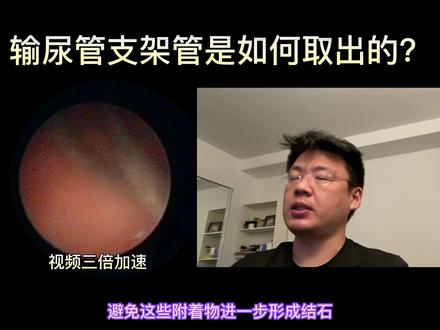 输尿管支架管是如何取出的?到底痛苦不痛苦?#输尿管支架 #膀胱镜 #膀胱镜检查 #肾结石 #输尿管结石