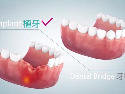 种植牙比烤瓷桥,到底好在哪?你看出来了吗#dou出新知 #郑州