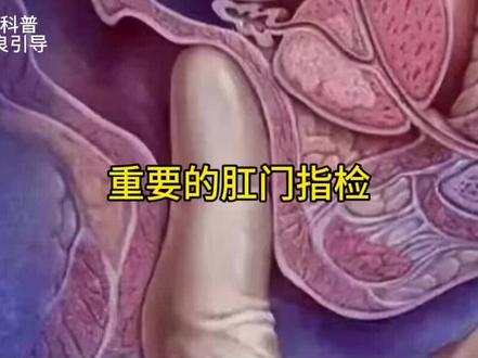 为什么要用手指检查肛门#肛肠科 #便血 #直肠癌
