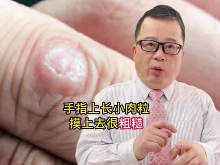手指长小肉粒,这可能是寻常疣#科普 #关爱女性健康