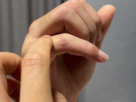 细讲一下康复第九天的重大进展,所以一定要用好方法,狠得下心!希望对正在或即将康复的大家有所帮助!#骨折恢复记录 #远离伤病