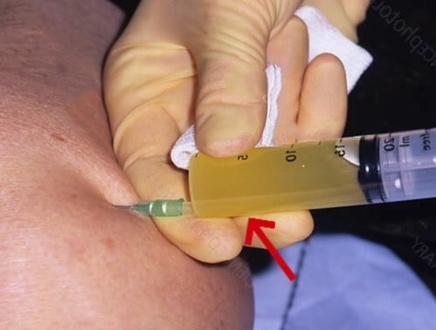 为什么有的人跑完步后膝关节会肿胀!