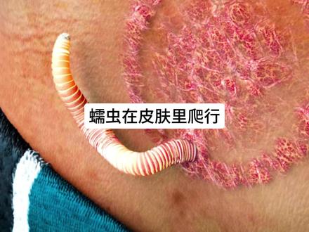 蠕虫真的会在皮肤里爬来爬去吗?#知识科普 #蠕虫 #人体