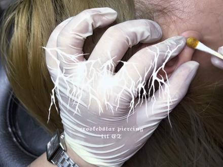 #扩耳 #工作日常记录 扩耳 4mm→6mm