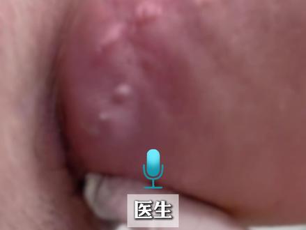 “医生,为什么偏偏是我会得这个病?”#化脓性汗腺炎 更偏爱这四类人,协和医生教你自查!#汗腺炎 #痘痘 #医学科普 #抖出健康知识宝藏
