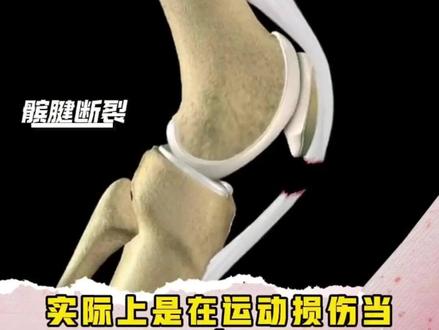 穆迪髌腱撕裂 到底有多严重? #穆迪 #髌腱断裂 #运动医学戈允申 #篮球运动损伤