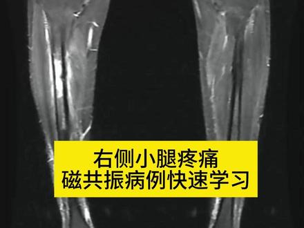 影像科医生好好看病中 手把手一起看CT片。最新一线病例。
现在确实方便了,一个二维码或者影像链接就能直接看图像了。#腿疼 #磁共振检查 #医学影像 #教学 #抖出健康知识宝藏