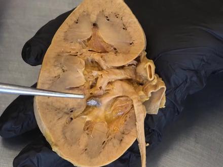 当你吃得太晚时,这是你的肾脏发生的变化。