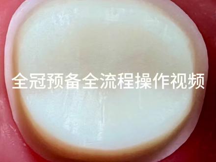 口腔技能考试全冠预备全流程操作 口腔技能考试全冠预备全流程操作(口外超级清晰版)!,⚠️大家预备时一定要注意好车针角度、预备力度哟!没追求速度,追求的是细节😄#口腔技能实践操作考试#全冠预备#铸造金属全冠预备 #口腔执业医师考试#口腔助理医师考试