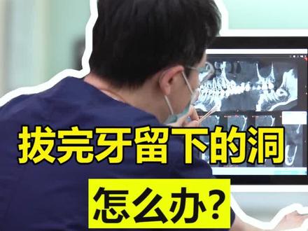 拔完牙后的大洞怎么办?通常医生会根据创口情况适当缝合,完全长好长平要1-3个月,这期间要注意创口出的清洁#口腔科刘博闻 #智齿 @抖音小助手