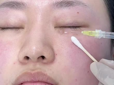 眼周三型胶原蛋白#原创作品 #抗衰 #变美 #眼周细纹