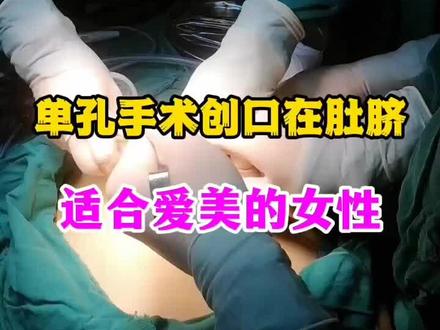 单孔腹腔镜手术的创口在肚脐,适合爱美女性#减重手术 #糖尿病#肥胖#减肥