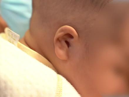 爸爸在孕期一天一包烟,宝宝出生耳朵是#畸形 ?#耳朵 #二手烟