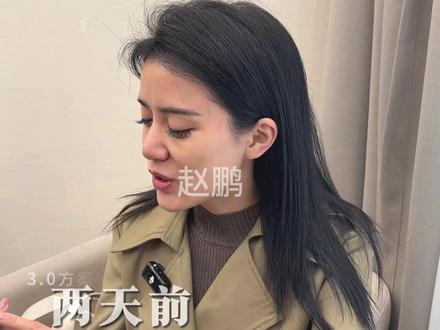 30+来上海花80000做完联合抗衰3.0方案后...没想到 效果因人而异 出镜人已签署相关肖像授权 出镜人已满25周岁!此视频不宣导任何风险医疗项目!#上海注射医生#法令纹#苹果肌下垂#赵鹏#面部提升