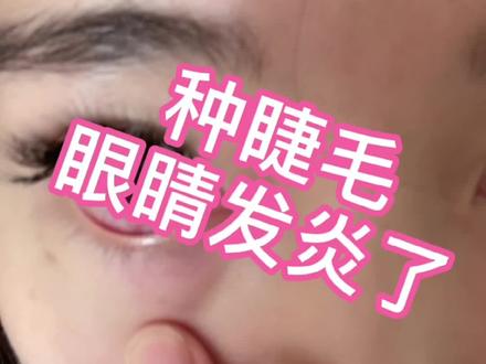 种完睫毛后眼睛就发炎了,两眼通红,你们一定要选个正规的机构,别像我这样。#种睫毛 #眼睛发炎