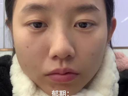 双向躁期和郁期的眼神变化#双向情感障碍 #躁期和郁期