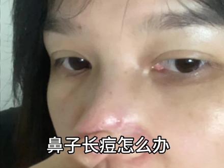 鼻子长痘怎么办#痘痘#毛孔粗大 #鼻子上长痘怎么解决