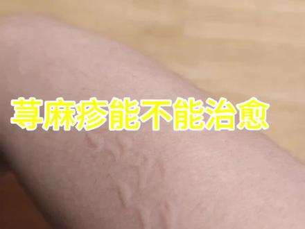 得了荨麻疹,到底能不能断根,有没有荨麻疹痊愈的小伙伴。从四月份开始,身体反反复复起疙瘩,一开始以为是螨虫,买了去螨虫的药,还是不管用,后面去医院说是荨麻疹,抵抗力不行,吃中药提高免疫力,吃西药控制荨麻疹,外用止痒药洗澡,因为在急性期,还是可以断根的,当时根本就没把荨麻疹当一回事,吃了两个星期的中药和西药,还以为没事了,结果刚停药两天,荨麻疹又卷头重来,端午就去了区医院,开了一个多星期的药,也是吃药就不痒,停药就痒,6月15日,去了乡下的一个老中医哪里开药,现在是吃中药的第三天,还是有些痒,我发现评论区有很多人留言,说得了荨麻疹,就一辈子断不了跟了,是真的吗,我很怕荨麻疹断不了跟,有把荨麻疹治疗好的小伙伴吗##记录生活 #荨麻疹是什么原因引起的 #荨麻疹的痛苦
