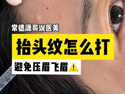 抬头纹一分钟演示:如何打可以尽量避免飞眉、压眉#抬头纹 #肉毒 #除皱针 #抬头纹不见了 #皮肤美容科陈潇