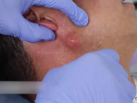 男人的耳朵下面长出囊肿,医生还没等动几刀,囊肿突然就破裂 #沉重人生减肥 #纳神医 #减肥