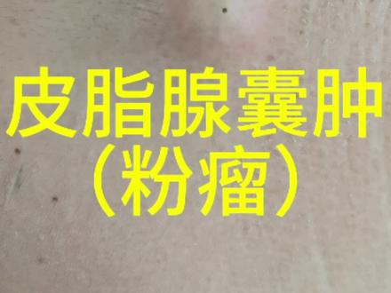 #粉瘤#皮脂腺囊肿
早晚得切除,感染后瘢痕更大,还是早点处理好。