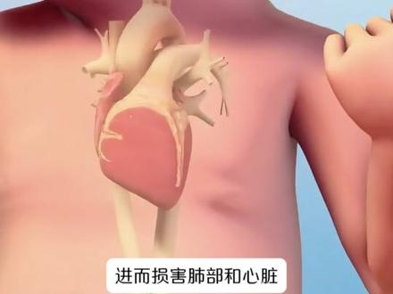 #医疗健康创作训练营 #硬核健康科普行动 这个病绝对会让你感叹人体构造的神奇#动脉导管未闭 #动脉导管封堵术 #先天性心脏病