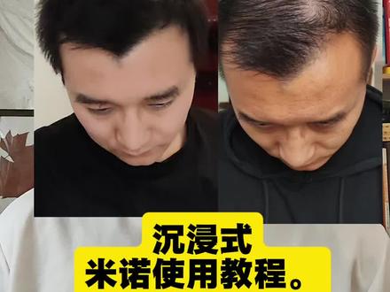 养发5个半月|米诺地尔保姆级教程,照着用就对了. 别再乱涂米诺了!正确使用手法全在这。附使用工具。#米诺地尔教程
#养发护发
#防脱生发
#米诺地尔使用方法
#护发干货