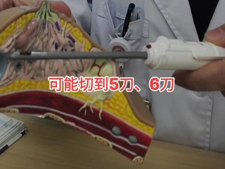 #乳腺结节 #乳腺 #乳腺结节微创手术 #乳房微创手术