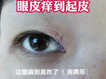 眼皮瘙痒,你可能要去看皮肤科了,这是#神经性皮炎 #医学科普 #皮肤 #瘙痒