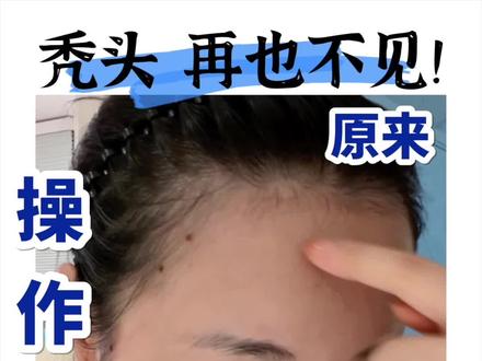 长毛毛具体操作方法来了!!视频里说不了的话放评论了嗷 #拯救发际线 #发量 #秃头 #秃头少女 #头发稀疏