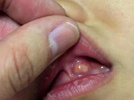 #儿童口腔 #口腔健康 #勇敢的宝宝 #根管治疗 1月份孩子说大门牙痛,吃东西都不敢咬。带他去口腔医院看,医生说牙龈发炎,建议根管治疗。我们想着这么小的孩子,可能不太配合,先选择保守治疗,吃点消炎药看看。那时正好要过年了,吃了几天药,娃说不疼了,我们也就把这事放下了。一个月后,给娃换衣服的时候,无意间发现他牙龈上长了个包,按压会痛。于是赶紧去医院,医生说之前吃药治标不治本,现在变成牙尖炎了。乳牙牙神经已经坏死。检查后,发现隔壁大门牙也发炎了😭。两颗牙都要根管治疗。于是乎,开启漫长的治疗之路。因为小朋友不像成年人那样配合,所以原本3次就能完成的治疗,需要根据孩子的情况进行调整。原来的女医生中途休假,换成了一个男医生。男医生看了2次,再也看不下去了,说到底还是对小孩缺乏耐心以及和孩子沟通的能力欠佳。所幸后来主任接手,孩子也慢慢克服对治疗的恐惧。其实我也挺佩服这孩子的,我自己做根管治疗的时候,都差点忍受不了。何况是个孩子呢!希望大家多关注孩子的口腔健康,少吃甜食和糖果,勤刷牙。不要觉得反正孩子大了要换牙,就可着乳牙使劲造。乳牙是会影响恒牙的生长的,一定要保护好乳牙!