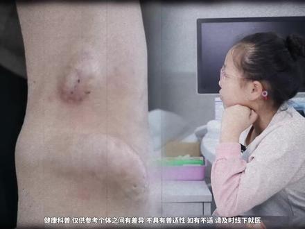 为什么要少喝饮料,看了就知道了 #尿毒症晚期 #关爱女性健康 #奶茶 #抖出健康知识宝藏 #我的年度健康盘点