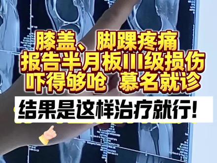 膝盖、脚踝疼痛报告半月板III级损伤吓得够呛 慕名就诊结果… 膝盖、脚踝疼痛 报告半月板III级损伤,吓得够呛 慕名就诊,结果是这样治疗就行!
#半月板损伤 #胫骨结节骨骺炎 #韧带损伤 #运动医学张晋 #抖出健康知识宝藏
