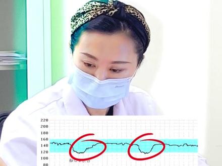 胎心监护 胎心加速和胎心减速的区别