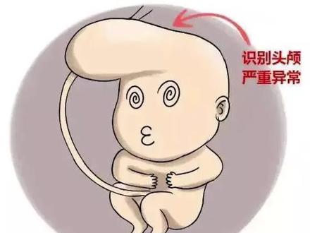 孕中期6个月左右,查出胎儿疑似脑积水,这个孩子还能要吗?马叔:看具体数值!#孕中期产检 #胎儿侧脑室增宽 #医学科普 #父母必看系列